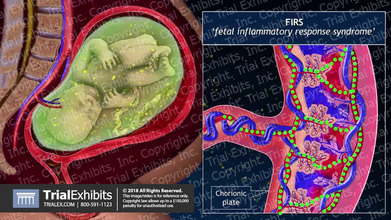medicina-fetal-barcelona-corioamnionitis - Barcelona Noticias 24h medicina fetal barcelona corioamnionitis