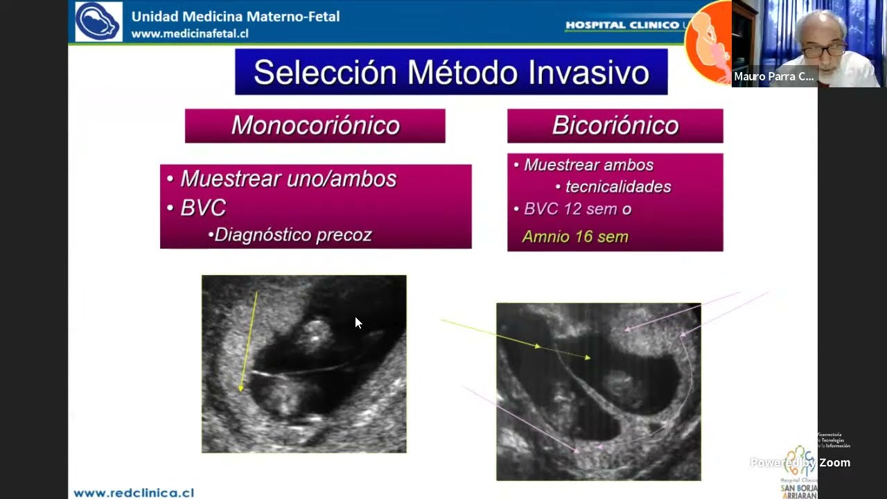 medicina fetal barcelona embarazo gemelar